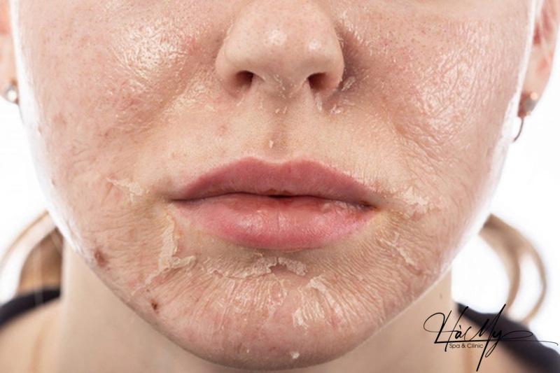 Làn da của bạn sẽ như thế nào sau Peel? (Nguồn: Internet)