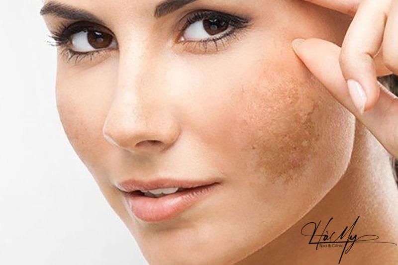 Top 5 Spa trị nám Uy tín tại Hà Tĩnh 6 Nám da nỗi ám ảnh chung tất cả phụ nữ (Nguồn: Internet)