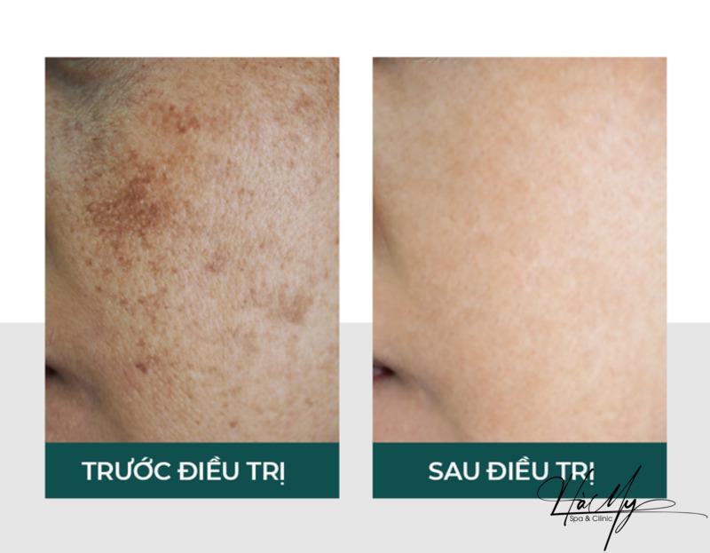 Top 5 Spa trị nám Uy tín tại Hà Tĩnh 7 Da trắng hồng, hết nám sau khi trị tại spa (Nguồn: Internet)