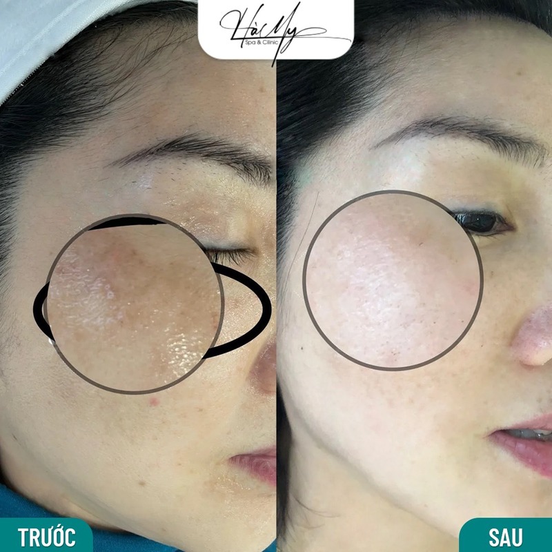 Top 5 Spa trị nám Uy tín tại Hà Tĩnh 10 Spa trị nám an toàn cho khách hàng (Nguồn: Hà My Spa)