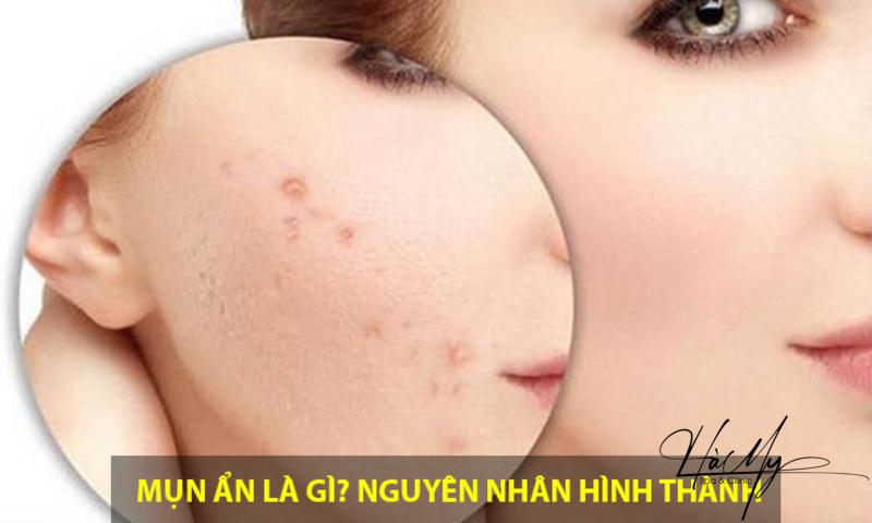 Ăn gì để giảm mụn ẩn? - Hiệu quả nhanh chóng 6 Mụn ẩn là gì (Nguồn: Internet)