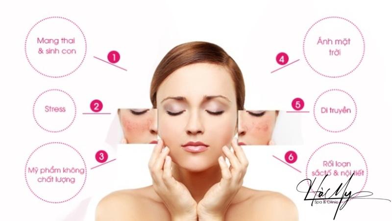 Hướng dẫn các bước chăm sóc da nám bạn cần biết 5 Những điều phải biết nếu muốn điều trị nám (Nguồn: Internet)