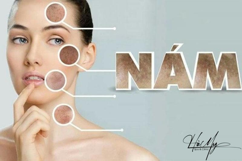 Hướng dẫn các bước chăm sóc da nám bạn cần biết 6 Các loại nám có thể xuất hiện (Nguồn: Internet)