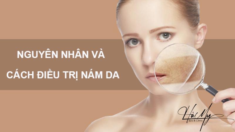 Hướng dẫn các bước chăm sóc da nám bạn cần biết 7 Nguyên nhân và các bước điều trị nám (Nguồn: Internet)
