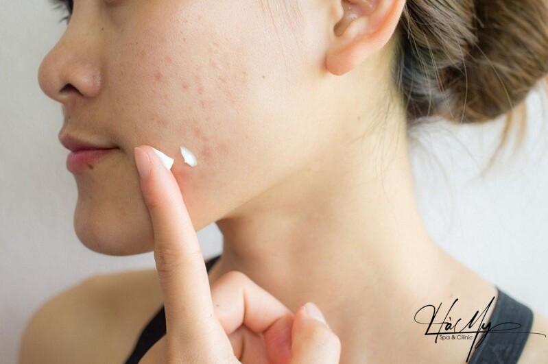5 cách đẩy mụn ẩn hiệu quả và an toàn 9 Sử dụng kem đẩy mụn ẩn (Nguồn: Internet)