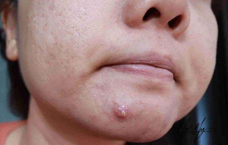 Cách giảm sưng mụn bọc hiệu quả và an toàn 10 Vết sưng mụn là dấu hiệu của sự viêm nhiễm ở da, do vi khuẩn gây ra (Nguồn: Internet)