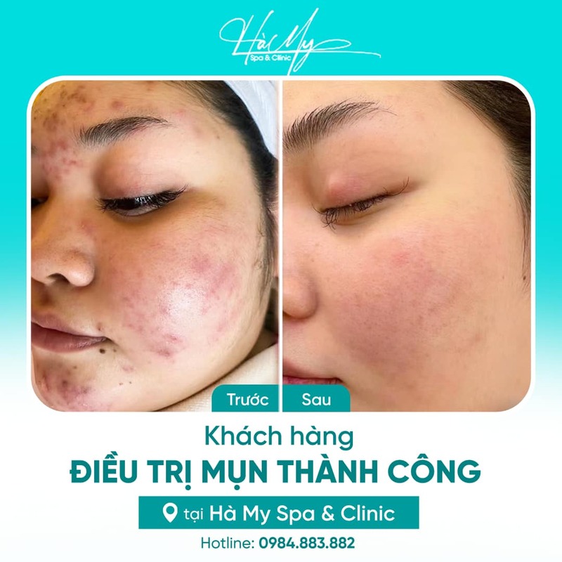 Cách giảm sưng mụn bọc hiệu quả và an toàn 18 Khách hàng điều trị mụn tại Hà My Spa (Nguồn: Hà My Spa)