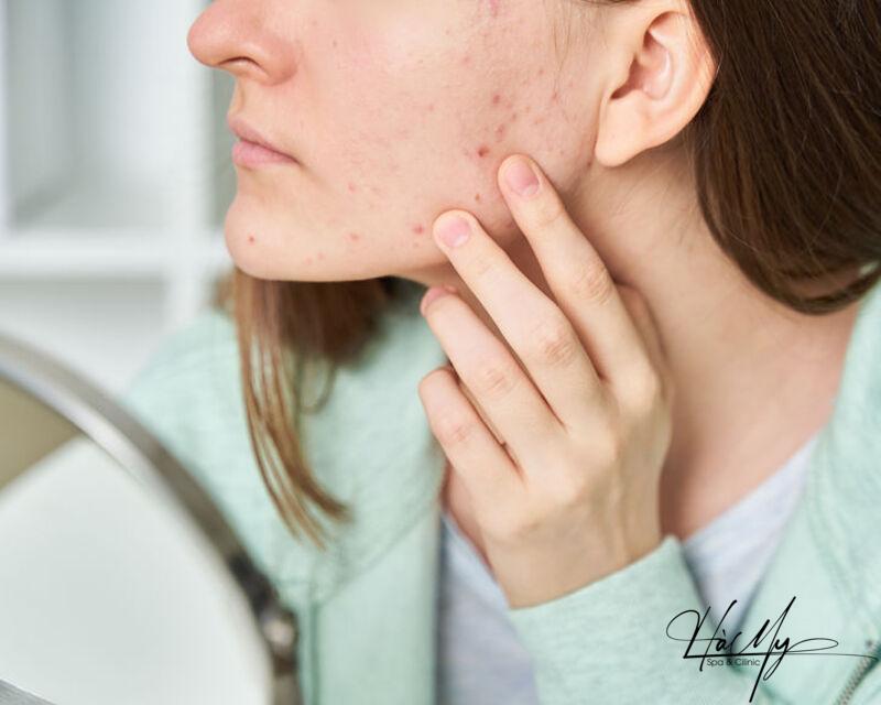 Cách Trị Mụn Ẩn 2 Bên Má An Toàn Hiệu Quả 5 Mụn ẩn ở má là mụn nằm sâu trong nang lông (Nguồn: Internet)