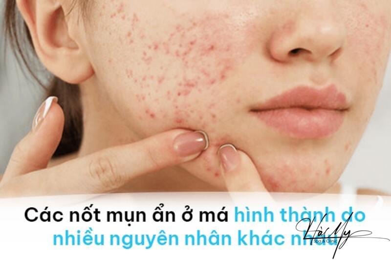 Cách Trị Mụn Ẩn 2 Bên Má An Toàn Hiệu Quả 6 Nguyên nhân gây mụn ẩn 2 bên má (Nguồn: Internet)