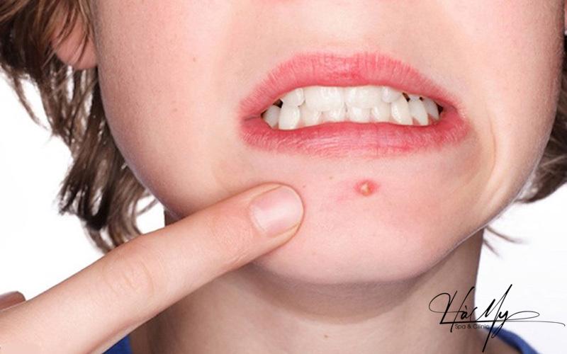 Cách trị mụn bọc bị chai an toàn không để lại sẹo 5 Bã nhờn khiến lỗ chân lông bít tắc, gây nổi mụn bọc. (Nguồn: Internet)