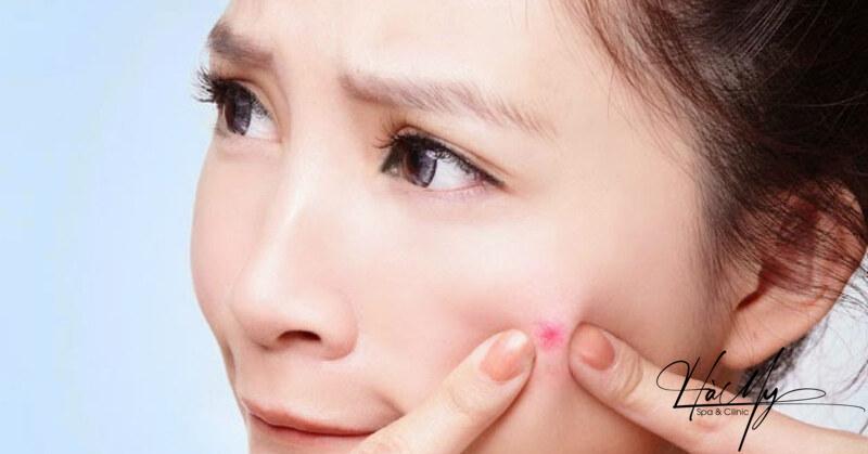 Cách trị mụn bọc bị chai an toàn không để lại sẹo 6 Nguyên nhân gây mụn bọc bị chai (Nguồn: Internet)