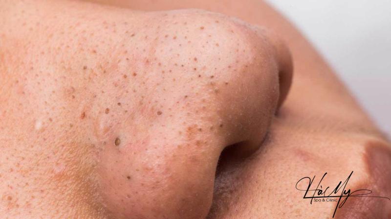 Cách Chăm Sóc Da Bị Mụn Đầu Đen Hiệu Quả 5 Mụn đầu đen thường xuất hiện ở vùng da mũi (Nguồn: Internet)