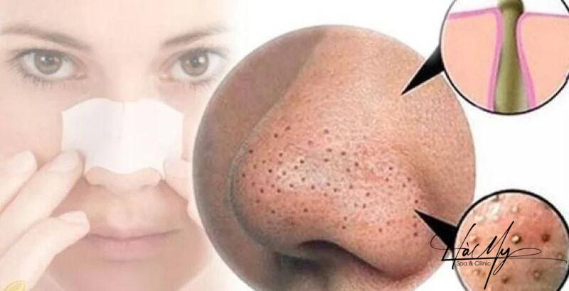 Cách Chăm Sóc Da Bị Mụn Đầu Đen Hiệu Quả 6 Cách chăm sóc da bị mụn đầu đen (Nguồn: Internet)