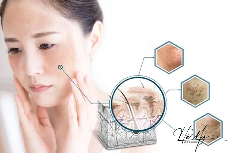 Cơ chế điều trị nám - Bí quyết giúp bạn sở hữu làn da trắng sáng 9 Nám da có thể có nhiều hình dạng, kích thước, và màu sắc khác nhau (Nguồn: Internet)