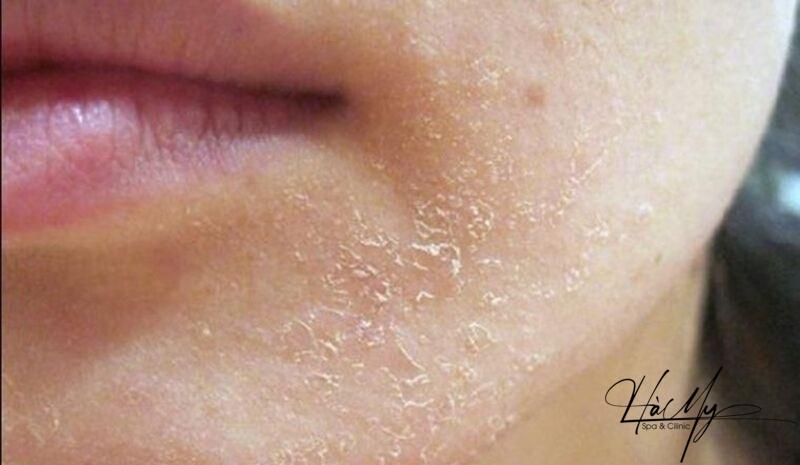 7 Dấu Hiệu Làn Da Bị Hư Tổn - Những Điều Bạn Cần Biết 6 Da khô, bong tróc dấu hiệu làn da bị hư tổn (Nguồn: Internet)