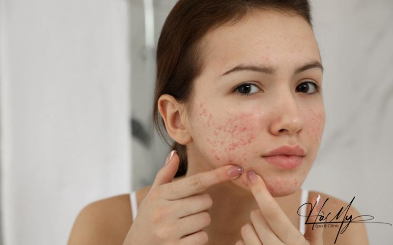 7 Dấu Hiệu Làn Da Bị Hư Tổn - Những Điều Bạn Cần Biết 7 Làn da bị mụn tàn phá nghiêm trọng dấu hiệu làn da bị hư tổn (Nguồn: Internet)