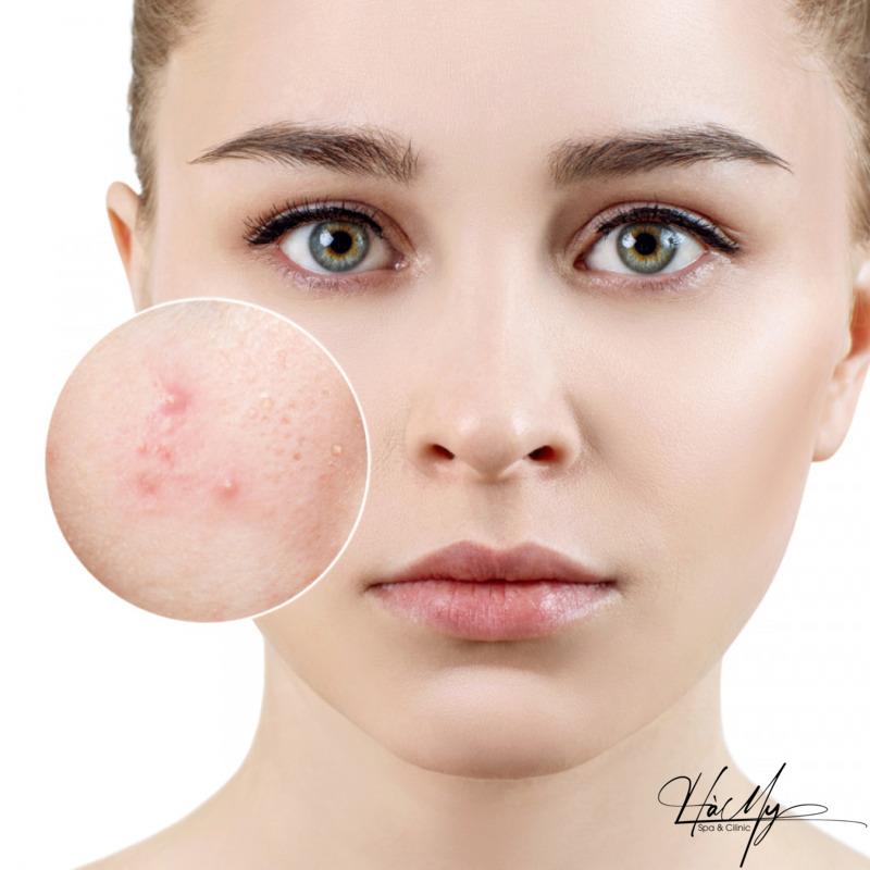 Dịch vụ điều trị mụn uy tín tại Hà Tĩnh - Bảng giá mới nhất 5 Dịch vụ điều trị mụn chuẩn y khoa là gì? (Nguồn: Internet)