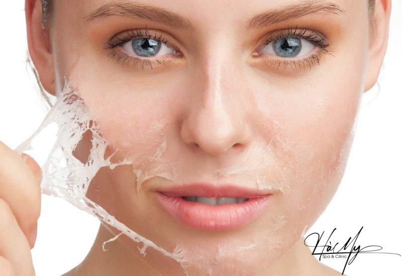Dịch vụ Peel da, Chemical Peel uy tín - Bảng giá Peel da mới nhất 5 Phương pháp peel da đang được nhiều chị em tin dùng (Nguồn: Internet)