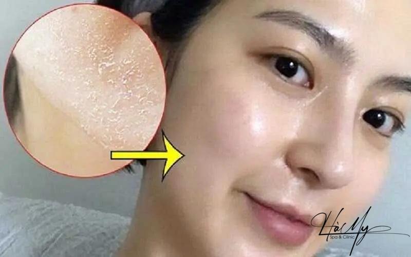 Dịch vụ Peel da, Chemical Peel uy tín - Bảng giá Peel da mới nhất 8 Làn da thay đôi sau khi peel da (Nguồn: Internet)