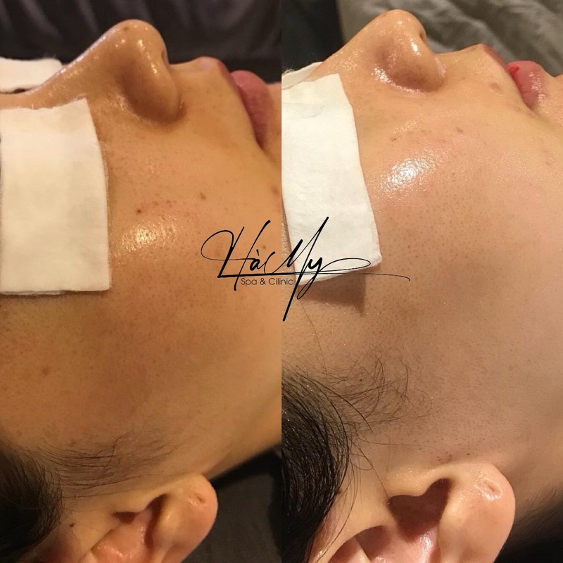 Dịch vụ tiêm meso trẻ hóa da uy tín, hiệu quả - Hà My Spa 6 Dịch vụ Tiêm Meso trẻ hóa uy tín, chất lượng tại Hà My Spa (Nguồn: Hà My Spa)