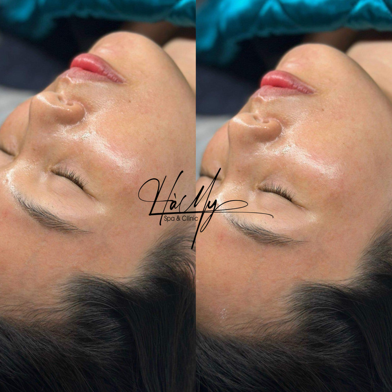Dịch vụ tiêm meso trẻ hóa da uy tín, hiệu quả - Hà My Spa 8 Hình ảnh khách hàng dùng dịch vụ Tiêm Meso trẻ hóa tại Hà My Spa (Nguồn: Hà My Spa)