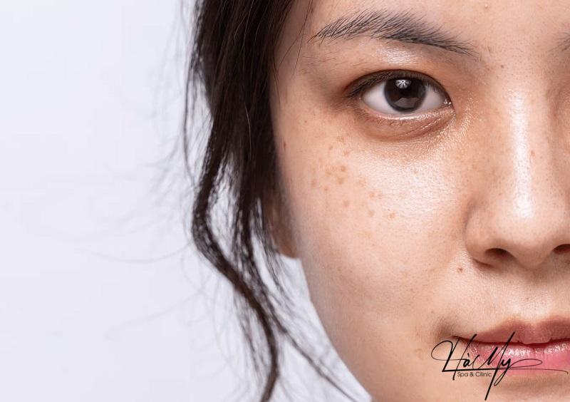 Điều trị nám chân đinh - An toàn và hiệu quả 9 Điều trị nám chân đinh tại Hà My Spa an toàn và hiệu quả nhất hiện nay (Nguồn: Hà My Spa)