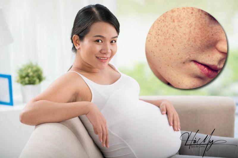 Điều trị nám da cho bà bầu - Những điều cần biết 5 Điều trị nám da cho bà bầu (Nguồn: Internet)