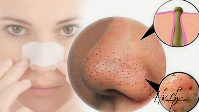 Cách Điều Trị Mụn Đầu Đen Bạn Cần Biết 5 Mụn đầu đen ở mũi (Nguồn: Internet)