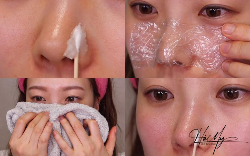 Cách Điều Trị Mụn Đầu Đen Bạn Cần Biết 6 Điều trị trị mụn đầu đen tại spa (Nguồn: Internet)