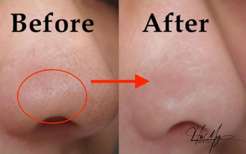 Cách Điều Trị Mụn Đầu Đen Bạn Cần Biết 8 Trước và sau khi điều trị trị mụn đầu đen (Nguồn: Internet)