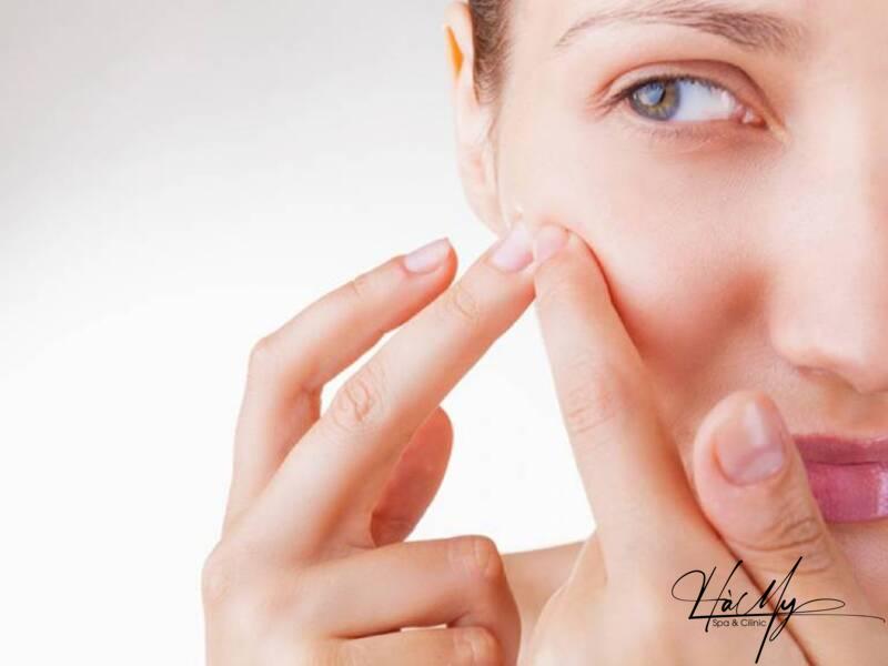 12 lời khuyên trị mụn đơn giản mà hiệu quả 23 Tránh nặn, lể hay hút mụn gây nên viêm nhiễm (Nguồn: Internet)