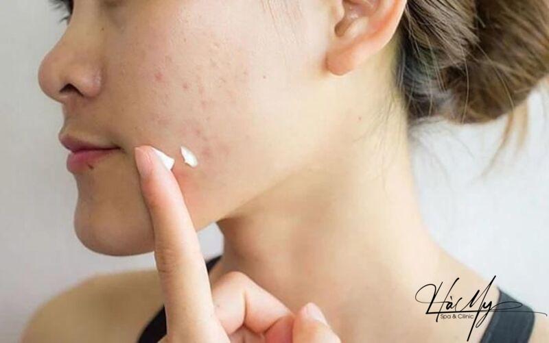 12 lời khuyên trị mụn đơn giản mà hiệu quả 15 Sử dụng kem chứa benzoyl peroxide để trị mụn hiệu quả (Nguồn: Internet)