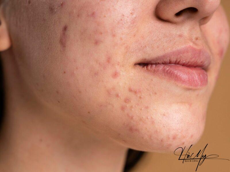 Mụn Ẩn Trị Hoài Không Hết Phải Làm Sao 5 Mụn ẩn có thể do bạn vệ sinh da chưa tốt (Nguồn: Internet)