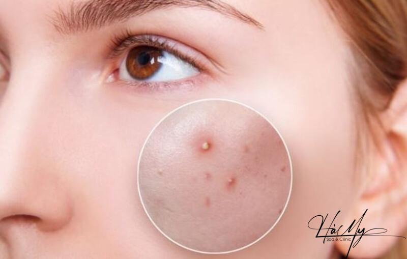 Peel da mụn có hiệu quả không? Ưu nhược điểm của Peel da mụn 7 Peel da không áp dụng với những vùng da bị mụn bọc, mụn mủ (Nguồn: Internet)