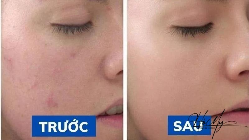 Peel da mụn có hiệu quả không? Ưu nhược điểm của Peel da mụn 8 Làn da trắng hồng sau khi peel da mụn (Nguồn: Internet)