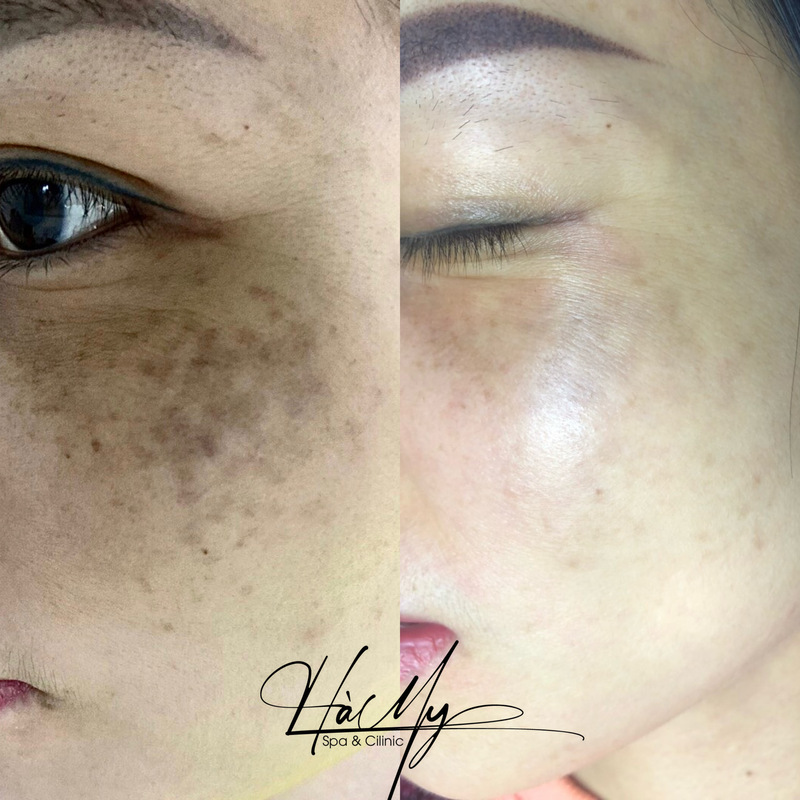 Các phương pháp điều trị nám da hiện nay 8 Khách hàng sử dụng dịch vụ điều trị nám tại Hà My Spa (Nguồn: Hà My Spa)
