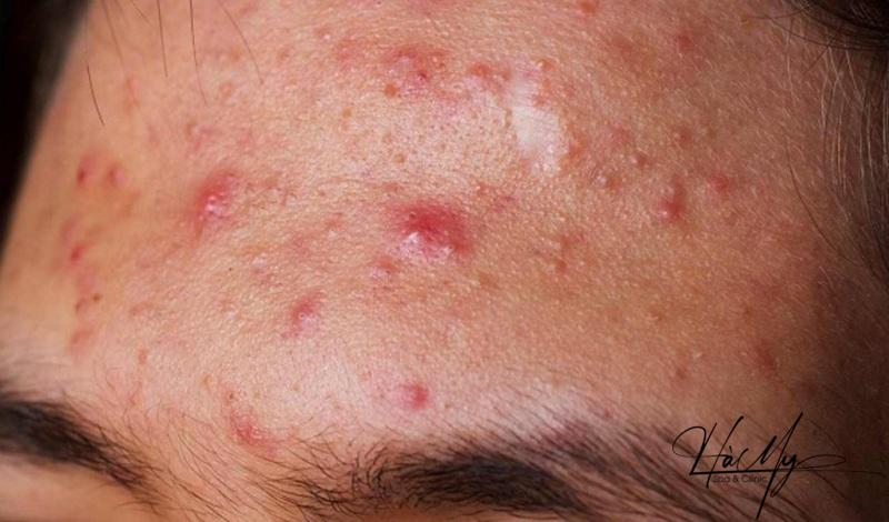 6 sai lầm khi trị mụn mà ai cũng mắc phải 7 Không nên sử dụng các loại sản phẩm không rõ nguồn gốc xuất xứ (Nguồn: Internet)