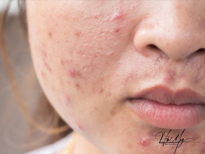 6 sai lầm khi trị mụn mà ai cũng mắc phải 10 Bạn nên kiểm tra định kỳ tình trạng da mặt tránh tình trạng xấu hơn (Nguồn: Internet)