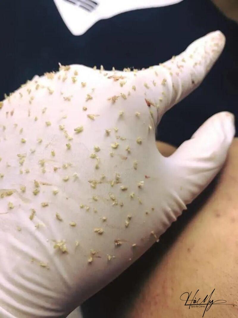 Top 10 Spa điều trị mụn uy tín Hà Tĩnh 9 Mụn nỗi lo của các chị em (Nguồn: Internet)