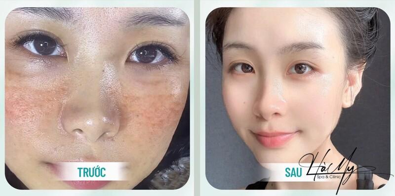 Top 10 Spa Điều Trị Tàn Nhang Uy Tín Hà Tĩnh Chất Lượng 9 Khách sử dụng dịch vụ tại Hà My Spa điều trị tàn nhang uy tín Hà Tĩnh (Nguồn: Hà My Spa)