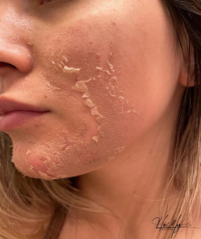 Tác Hại Của Peel Da Mà Bạn Nên Biết 6 Những nguy cơ rình rập khiến nhiều người e ngại khi peel da (Nguồn: Internet)