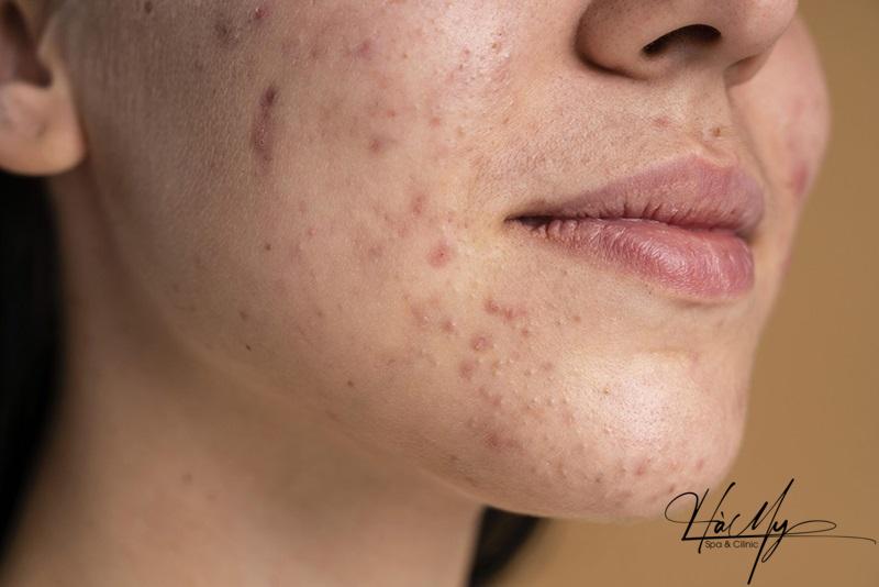 Tại sao càng skincare càng lên mụn? (Nguồn: Internet)