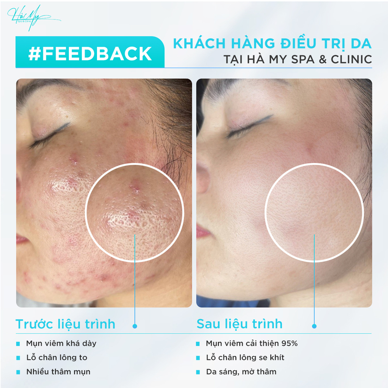 7 Tiêu chí chọn spa trị mụn uy tín, an toàn, hiệu quả tại Hà Tĩnh 12 Khách hàng điều trị da mụn tại Hà My Spa (Nguồn: Hà My Spa)