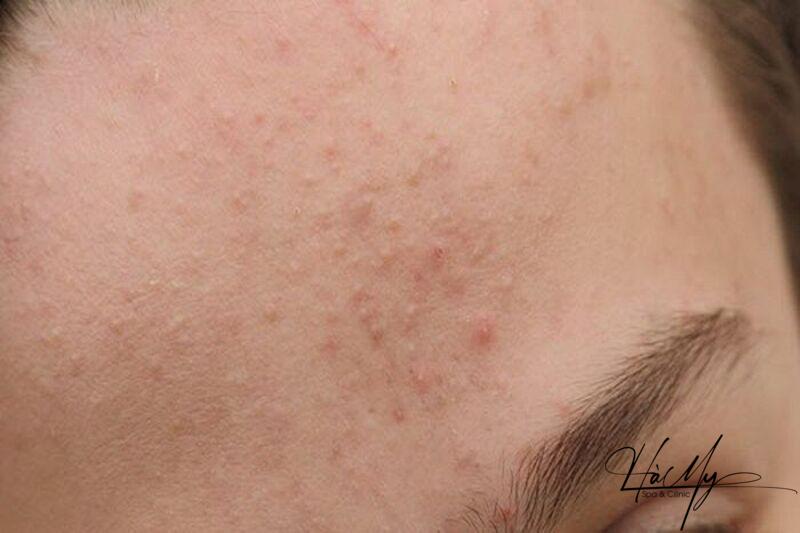Cách trị mụn ẩn an toàn hiệu quả 5 Mụn ẩn nằm bên dưới da thường khó phát hiện, chỉ sờ thấy cộm trên da (Nguồn: Internet)