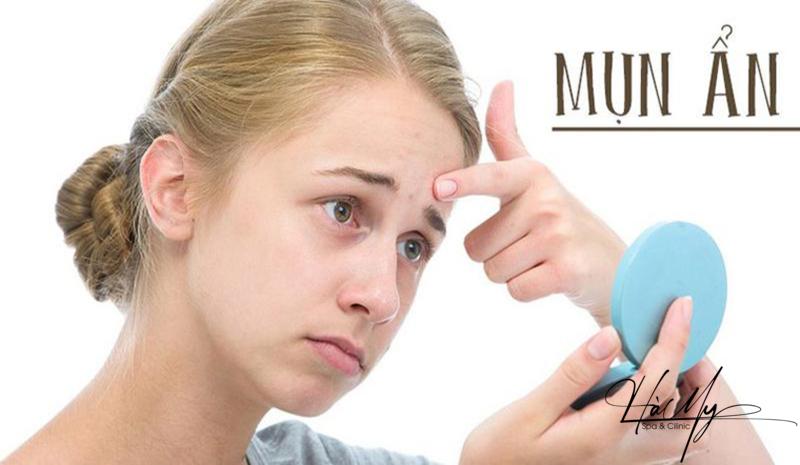 Cách trị mụn ẩn an toàn hiệu quả 6 Mụn ẩn thường gặp trên da (Nguồn: Internet)
