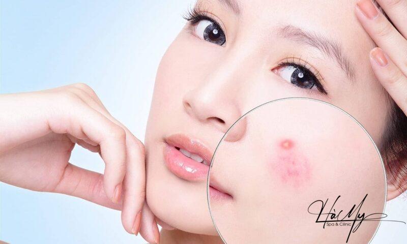 Cách trị mụn ẩn an toàn hiệu quả 7 Giữ vệ sinh sạch sẽ là một trong những cách phòng ngừa mụn ẩn (Nguồn: Internet)