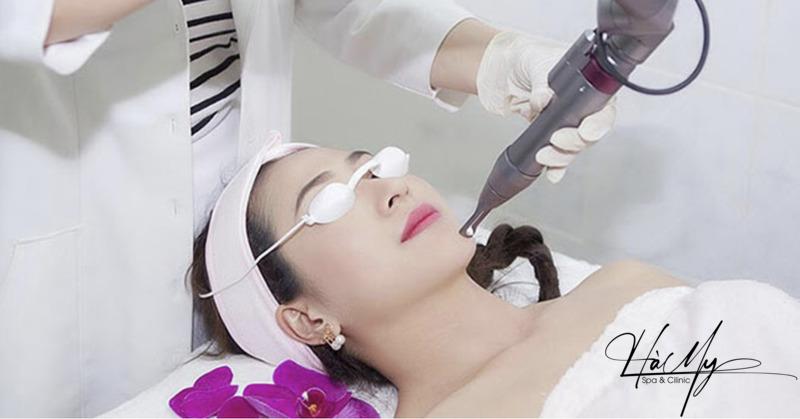 Các loại laser trị nám tốt nhất hiện nay 8 Trị nám bằng công nghệ Meso Aqua Skin (Nguồn: Hà My Spa)