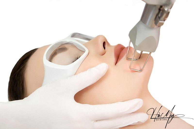 Các loại laser trị nám tốt nhất hiện nay 10 Trị nám bằng công nghệ Laser Toning (Nguồn: Hà My Spa)