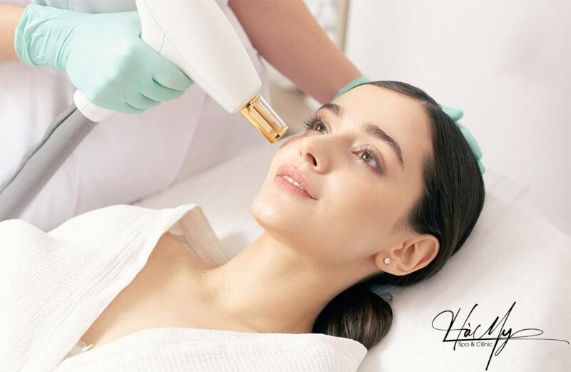 Các loại laser trị nám tốt nhất hiện nay 11 Trị nám kết hợp Laser Fractional CO2 và PRP (Nguồn: Hà My Spa)