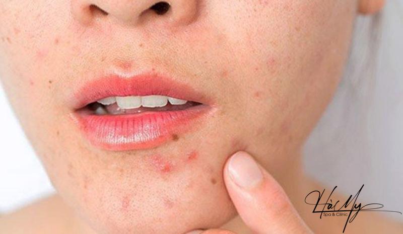 9 cách điều trị mụn trứng cá tuổi dậy thì an toàn và hiệu quả 7 Không nặn mụn khi mặt xuất hiện mụn trứng cá (Nguồn: Internet)